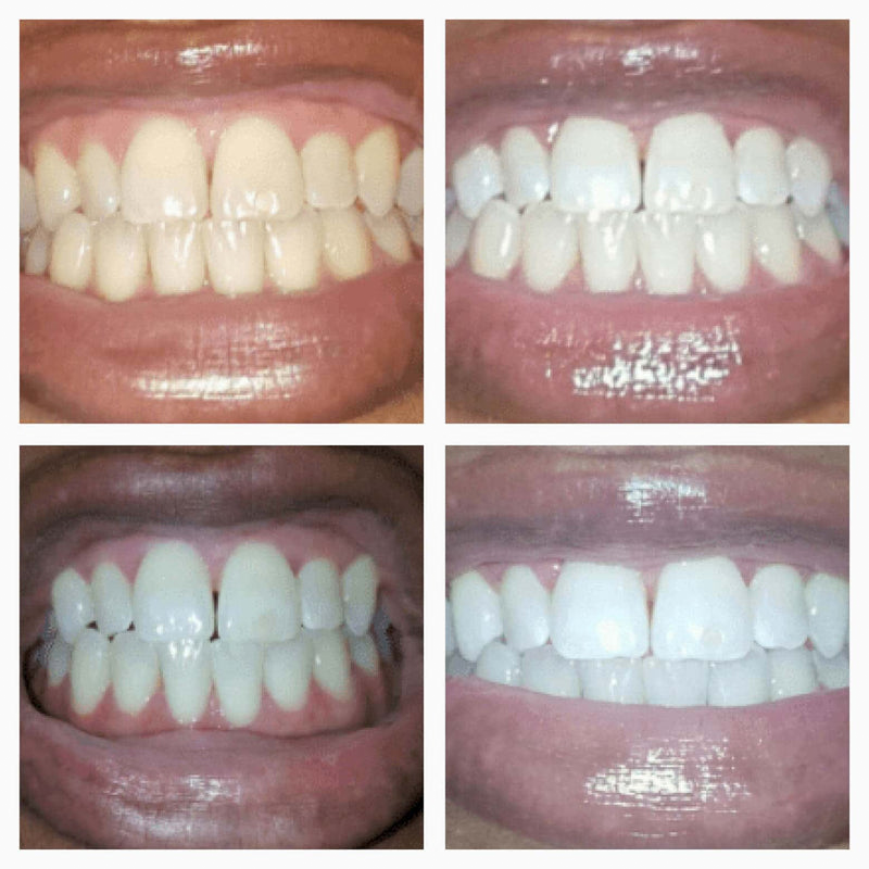 Fubsta® Extra-Strength Teeth Whitening Serum Pen + Dual-Peroxide Formula & Xylitol