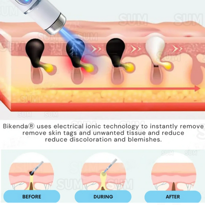 ✨Bikenda®Non-Invasive Skin Imperfection Removal Pen✨(safe)