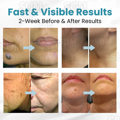 ✨Bikenda®Non-Invasive Skin Imperfection Removal Pen✨(safe)