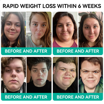 [See results in 7 days]🌍Tnnedey® 𝑺𝑴𝑮𝑻-𝑮𝑳𝑷-1 𝑵𝒂𝒏𝒐 𝑴𝒊𝒄𝒓𝒐𝒏𝒆𝒆𝒅𝒍𝒆 𝑷𝒂𝒕𝒄𝒉（Painless, long-lasting, addressing diabetes, obesity, and cardiovascular diseases）